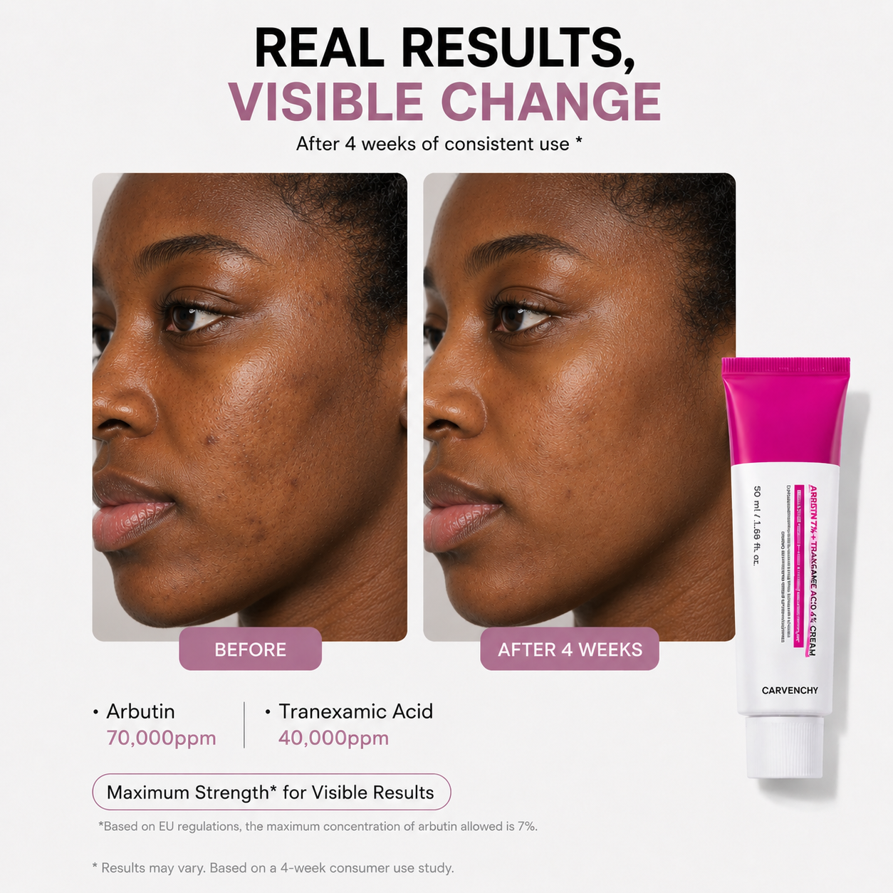 Arbutin 7% + Tranexamic Acid 4% Cream