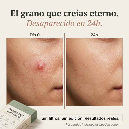 Parches Led Anti Acné